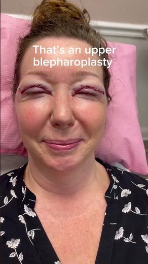 BLEPHAROPLASTY BEFORE AND AFTER - DR. TANVEER JANJUA