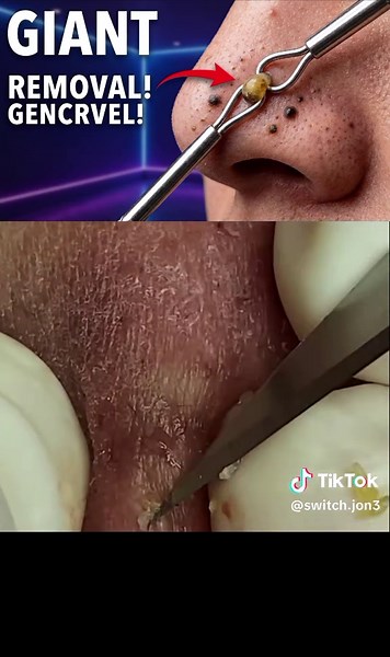 Giant Blackhead Removal Compilation 😱 | Most Satisfying Acne & Pimple Extraction Ever Watch the most satisfying blackhead removal and acne extraction compilation! Experience deep pore cleaning, giant blackhead extraction, and relaxing skincare moments. This oddly satisfying video is perfect for skincare lovers who enjoy pimple popping, blackhead removal, and pore cleansing videos. Watch till the end for the most satisfying extraction results! #BlackheadRemoval #AcneExtraction #PimplePopping #Sa