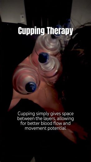 NECK CUPPING Therapy😍 #cupping