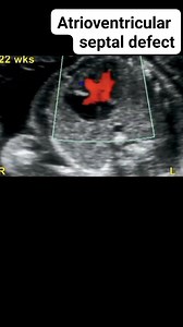 273 reactions · 63 shares | Atrioventricular septal defect on ultrasound #radiology #sonography #ultrasoundlearning #RadiologyEducation #diagnosticultrasound | Radiology Interesting | Facebook