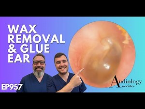 WAX REMOVAL AND GLUE EAR: WHAT IS GLUE EAR? - EP957