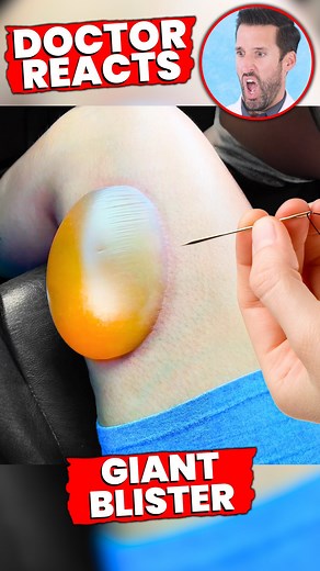 Doctor ER on Instagram: "Doctor Reacts to “Very Satisfying” Blister Pop on Leg 🤯"