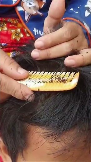 Thousand lice combing - Big lice removal
