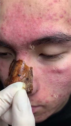 Acne & Blackhead Extraction | Extremely Satisfying 😌✨