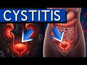 Cystitis Uncovered: The Ultimate Guide to Bladder Inflammation, Symptoms, Causes, and Treatments