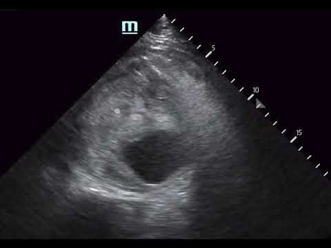 Ruptured Abdominal Aortic Aneurysm