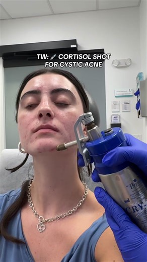TW: NEEDLES! Trying #cortisoneinjection for some painful and stubborn acne cysts! Check out my podcast episode with Dr. Danny Guo 🎙️🎧 have you done this type if procedure? 🥰❤️ #skinpositivity #hormonalacne #acnetreatment #acneskincare #skintreatment #beautyhacks
