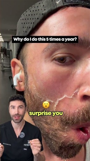 Why does your skin peel after a chemical peel? #chemicalpeel #peeling #skincare #antiaging #acne