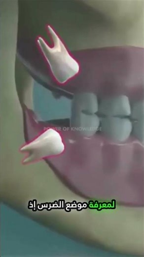 كيف يُخلع ضرس العقل خطوة بخطوة؟ 🦷😬