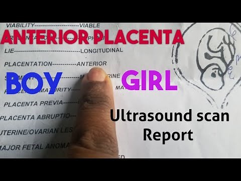 Anterior Placenta Baby Gender(Ultrasound Scan Report)