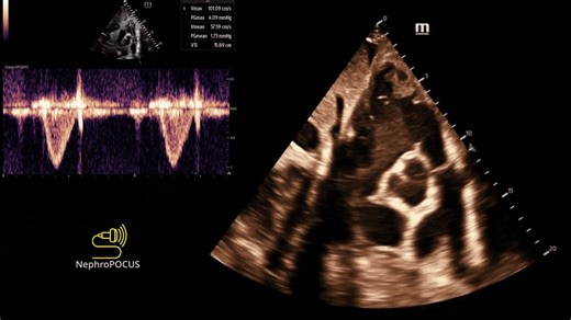 #POCUS #echofirst answer: 1️⃣ Subxiphoid short axis view at the aortic valve level 2️⃣ RVOT DopplerRVOT Doppler is one of the most underused but high yield tools.● Tracks RV stroke volume and cardiac outputSV = CSA × VTICO = SV × HRVTI alone works well for serial trends● Estimates pulmonary vascular resistancePVR = (TRV ÷ RVOT VTI) × 10 + 0.16● Screens for pulmonary hypertension even when TR jet is absentAccT 64 mmHg or velocity >4 m/s● Estimates pulmonary pressures from PR jetmPAP = 4(V peak PR