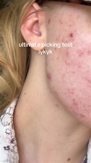 the jaw pimples are so easy and satisfying to pick 😭 #acne | pimple patches