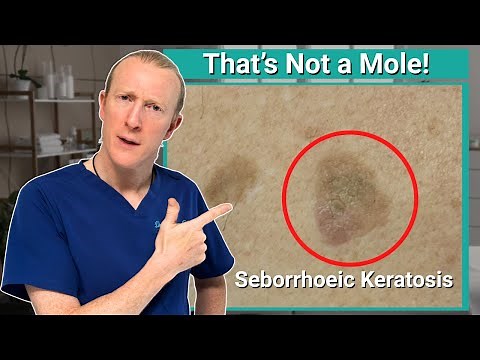 That's not a mole! Uncovering the Mystery of Seborrheic Keratosis