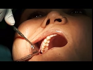 Difficult Upper Wisdom Tooth Extraction 😥 LIVE PROCEDURE