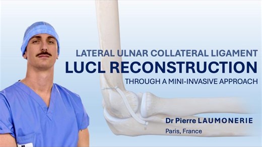 Elbow LUCL Reconstruction – Mini-Invasive Knotless Onlay Technique for PLRI | Step-by-Step Surgery | Pierre LAUMONERIE