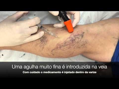 ESCLEROTERAPIA