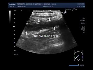 Ultrasound Video showing an inflamed appendix with a fecalith in it.