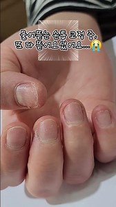 ​#물어뜯는손톱교정 또 다 뜯어오신 고객님...😭 긴급 복구 작전! (Before & After)