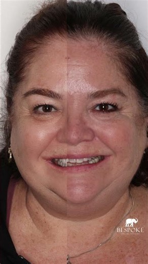 28 Veneers And Crowns One Smile #shorts