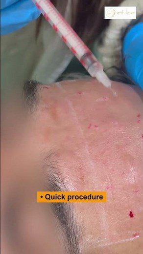 Forehead Botox: Smooth Lines Without Surgery #botox