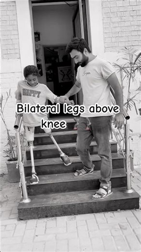 Walk Artificial above knee prosthesis legs / best use artificial above knee legs / #hassanzarar