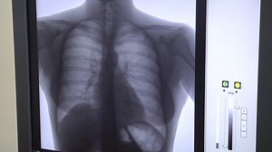 clip-1018993402-fluorography-lungs-on-computer-monitor