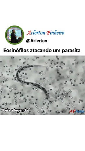 APhysio / Fisiologia, Farmacologia e Bioquímica on Instagram: "O eosinófilo é uma célula de defesa bem característica: tem núcleo em dois lobos e o citoplasma cheio de grânulos que guardam proteínas tóxicas, como a MBP (major basic protein), a ECP/EDN (ribonucleases) e a EPO (peroxidase). Ele não está ali só para inflamações alérgicas: tem papel em remodelamento tecidual, mas o grande destaque é o combate a parasitas multicelulares, como vermes. . O processo começa quando o tecido infectado libe