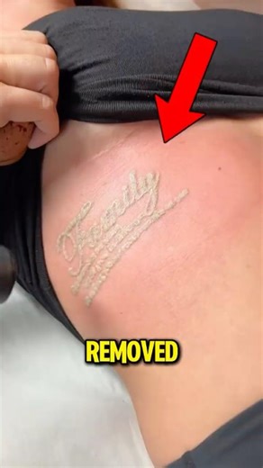 Laser Tattoo Removal Isn’t What You Think Here’s the Truth 😱