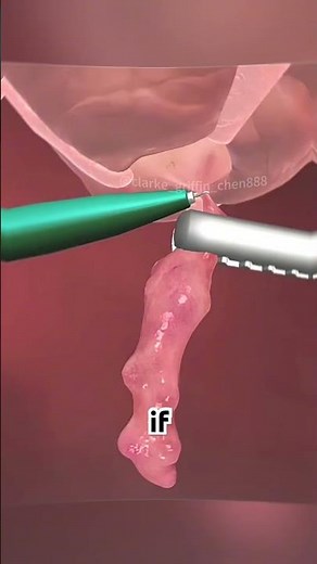 Appendix Removal Surgery (3D Animation) #appendix #removal #surgery #abdomen #medicine #appendectomy