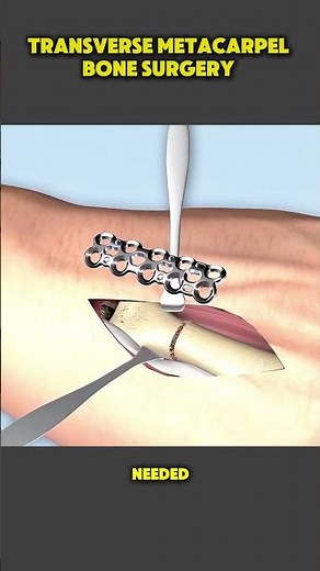 Transverse Metacarpal Bone Surgery Explained | Step-by-Step Surgical Procedure #MetacarpalSurgery