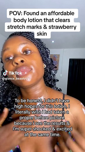 In this economy I’m all for affordable products that GETS THE JOB DONE!!😍😍 To be honest I didn’t have high hope for this lotion, I literally wish i had taken a proper before picture because i see the results & I’m super shocked & excited at the same time. Can you guess what lotion this is?!😍 dark spot strawberry skin best cream for strawberry skin cream for strawberry skin in nigeria get rid of stretch mark in nigeria best stretch mark review in nigeria best effective stretch mark removal . .