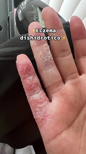 Productos para Calmar y Sanar la Piel con Eczema en las Manos