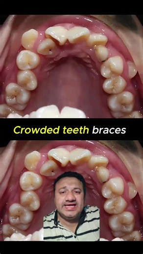 Braces Journey at Hamza Dental Clinic Clarkana — Larkana Dentist Tips