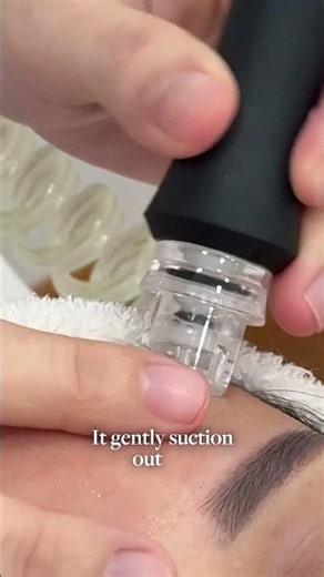 Struggling with oily skin & clogged pores?