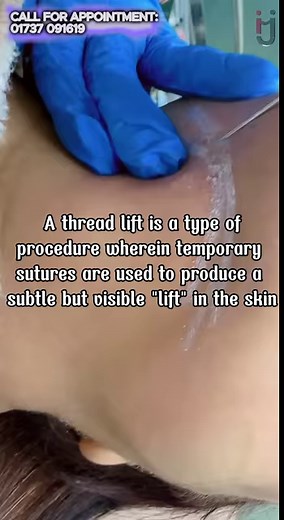 7.2K views · 45 reactions | Double Chin Reduction by ThreadLift  #doublechinreduction #doublchin #chinreduction #doublechintreatment | Dr. Israt Jahan | Facebook