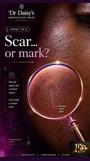 Acne Marks vs Acne Scars: The Difference Nobody Explains Part-1 #acne #skincare #scars