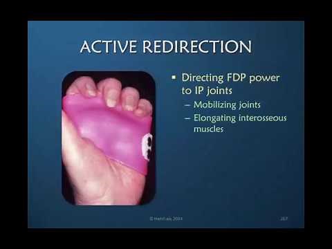 Nuances of Mobilizing the Stiff Hand: Part 8 of 9: Active Redirection
