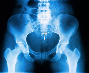 This Woman’s IUD Was Lodged in Her Abdomen for 11 Years—and She Had No Clue