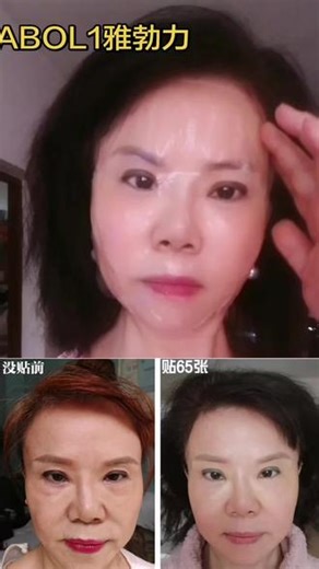 AB0L雅勃力抗衰：医美术后修复效果案例分享#抗衰真实案例对比