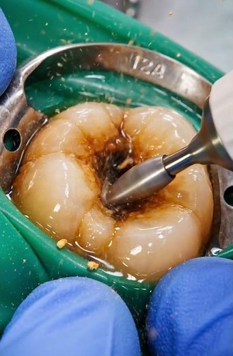 Satisfying Cavity Filling | Deep molar cavity restoration | Dental Treatment Animation #shorts
