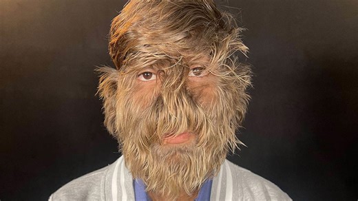 Teen with Rare ‘Werewolf Syndrome' Breaks World Record for Hairiest Face