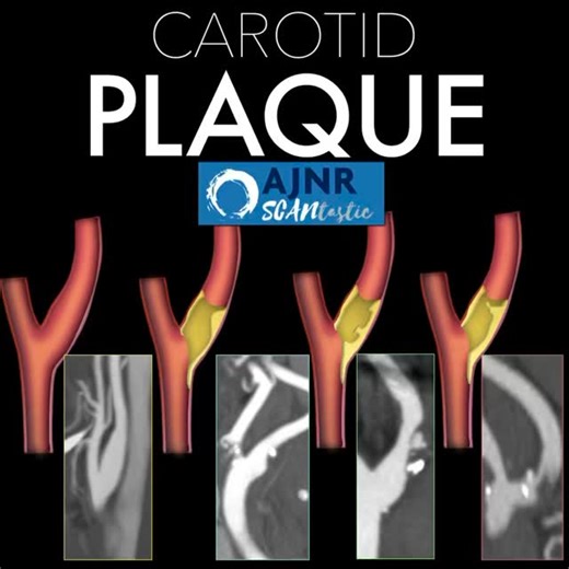 The 90s called & wants its carotid imaging back! It’s been 30 years—are you still on NASCET? Feeling vulnerable about plaque vulnerability? This month’s @the_ajnr SCANtastic has what you need to know about carotid plaque https://www.ajnr.org/content/46/10/2009 Carotid disease not only harms by stenosis but also by serving as a source of emboli. We can use carotid plaque-RADS, which has been adapted for CTA to identify high-risk plaques! Type 1 = no plaque. —Remember bc the number 1 looks like a 
