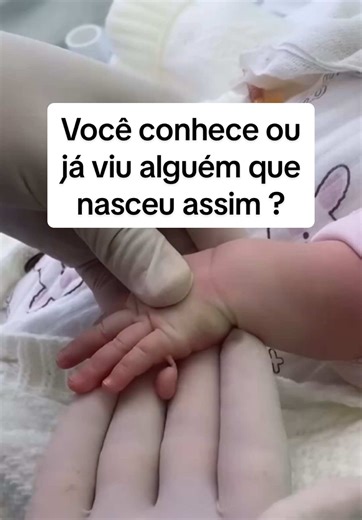 Polidactilia: O que é e como afeta recém-nascidos