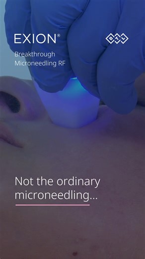 Not the ordinary microneedling method. 🪡 Your patients won't be scared to return for this treatment! 🥰 EXION delivers RF energy deep beyond the needles – minimizing patient discomfort. Want this face & body solution for your practice? See you in our DMs! 💬 #noninvasivetreatment #btlaesthetics #exion #fractionalrf #microneedling #exionfractionalrf #singlepass #microneedlingprocedure #microneedlingtherapy | BTL Aesthetics
