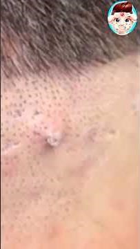 Dr. Lee Removes A Massive 55 Year Old Blackhead! | Dr. Pimple Popper