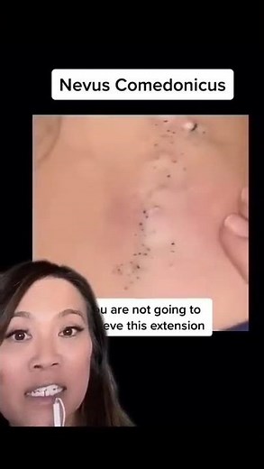 Why Do These Blackheads Look So Weird?