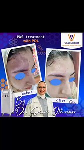 1.2K views · 842 reactions | Healing transformation magic ✨ #Vascuderm #Clinic #Laser #PulseDyeLaser #SkinCare #Portwinestain #فاسكوديرم #أمراض_جلدية #علاج_بالليزر #warts #ndyaglaser #Nordlys #Cutera_excelv #Derma_pen #mesotherapy #Fractional_laser | Vascuderm Clinic | Facebook