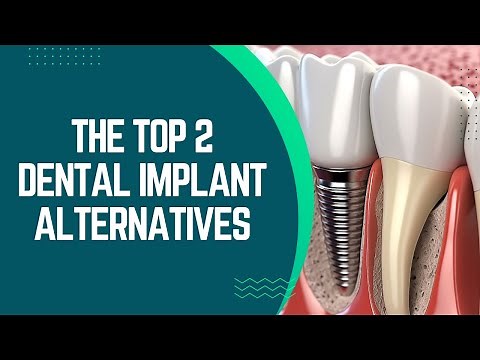 The Top 2 Dental Implant Alternatives: A Complete Guide