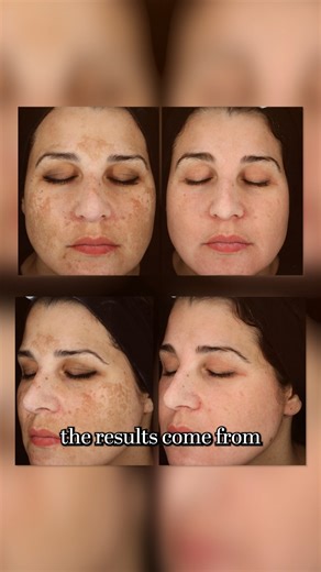 Art in Beauty | Pigmentation, melasma or stubborn dark spots? At Art in Beauty Med Aesthetic Clinic, we offer Cosmelan & Dermamelan Depigmentation Peel... | Instagram
