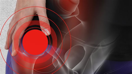 Avoid hip surgery with these proactive steps